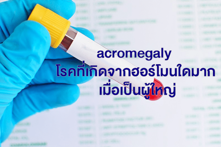 acromegaly โรคที่เกิดจากฮอร์โมนใดมาก เมื่อเป็นผู้ใหญ่