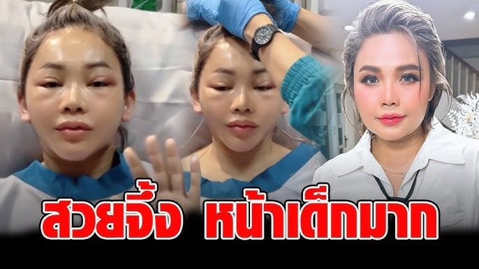 ตั๊กแตน ชลดา อัปเดตหน้าล่าสุดหลังทำศัลยกรรม การเปลี่ยนแปลงที่มากกว่าความสวยภายนอก